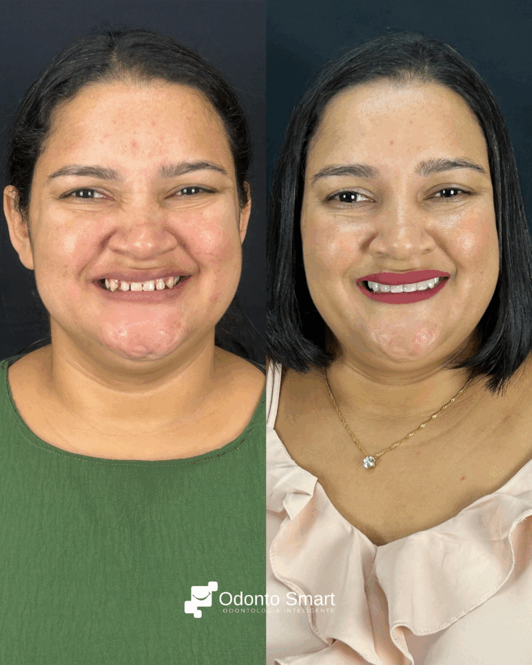 antes e depois odonto smart