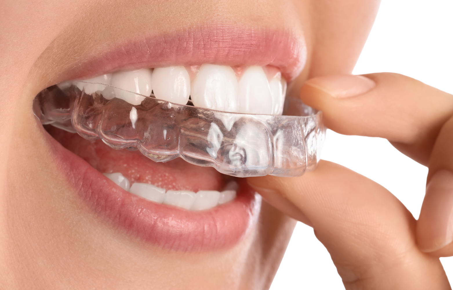 tratamentos odonto smart serra laranjeiras alinhadores invisiveis